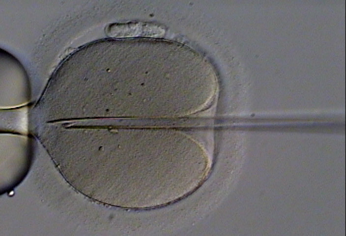 ICSI: a human egg held on a holding pipette while a single sperm is injected.